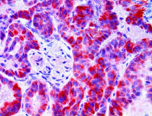 IHC of BRAF V600E on an FFPE Papillary Thyroid Carcinoma Tissue